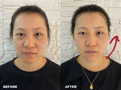 <b>RF</b> <b>Microneedling</b> is one of the most effective skin-tightening treatments to improve fine lines and wrinkles, especially around the eyes, mouth and cheeks. . Rf microneedling vs fractional co2
